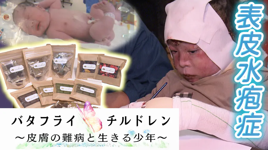バタフライチルドレン～皮膚の難病と生きる少年～